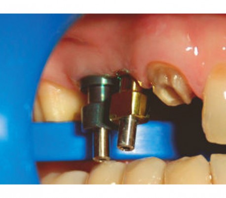 ماده-قالبگیری-elsodent-duroc (4)