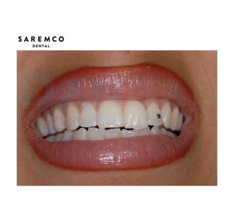 نگین-تزئینی-دندانپزشکی-saremco (2)