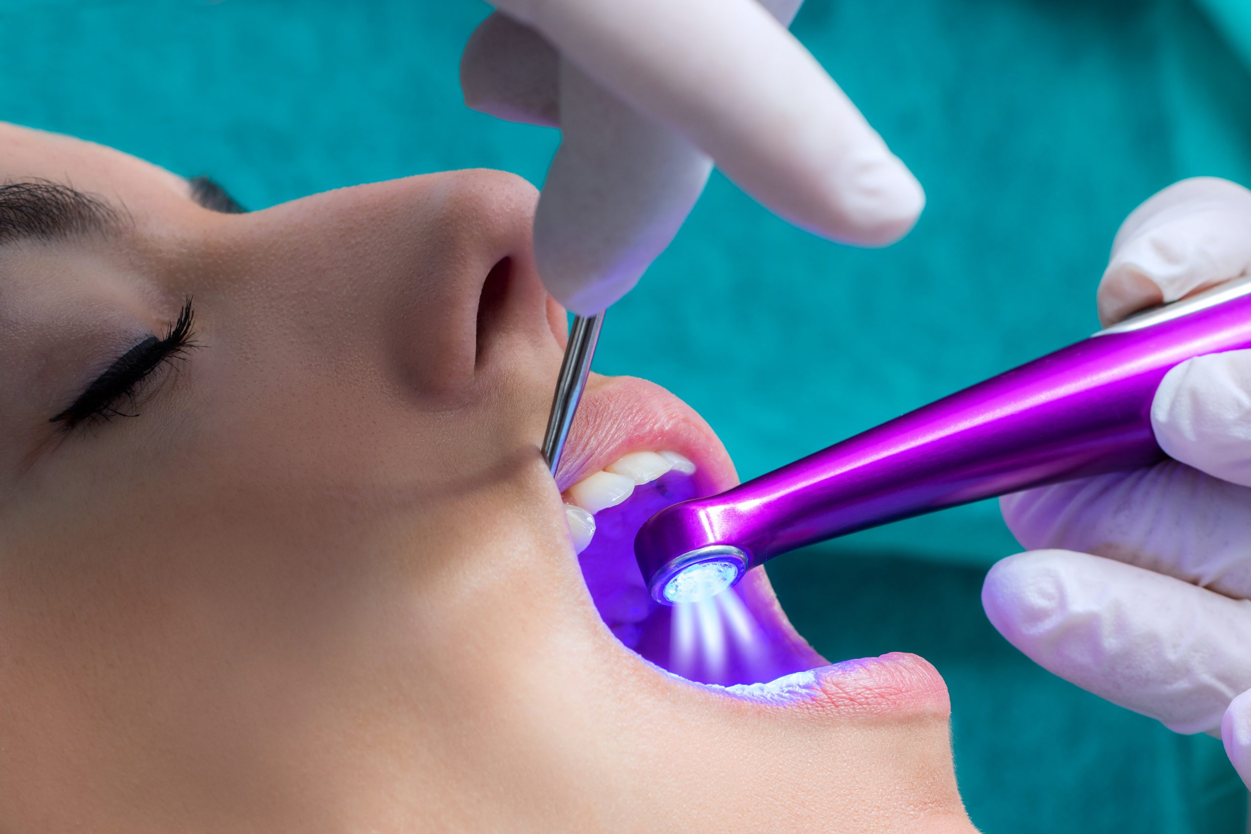 سیلر دندانپزشکی چیست