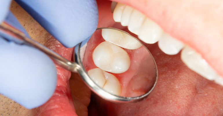 سیلر دندانپزشکی چیست