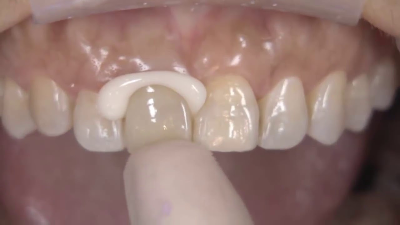 گلاس آینومر‌ در دندانپزشکی